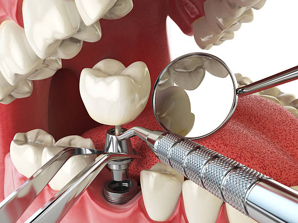Best Emergency Dentist for Knocked-Out Tooth in Decherd, TN
